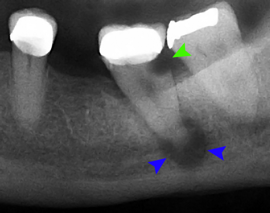 No Drill Dentistry Can Stop Tooth Decay