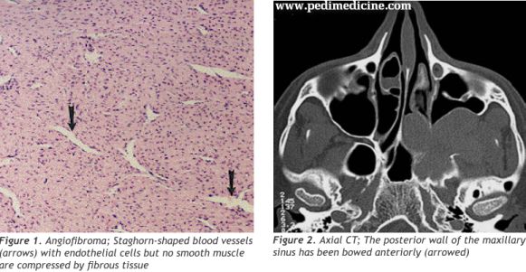 Juvenile Nasopharyngeal Angiofibroma CT Scan report