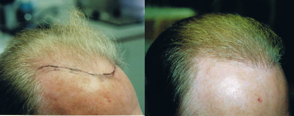 neograft hair transplant before and after results