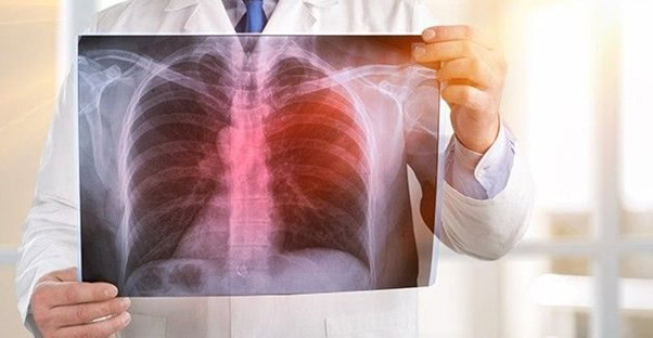 principais sinais e sintomas de pneumonia