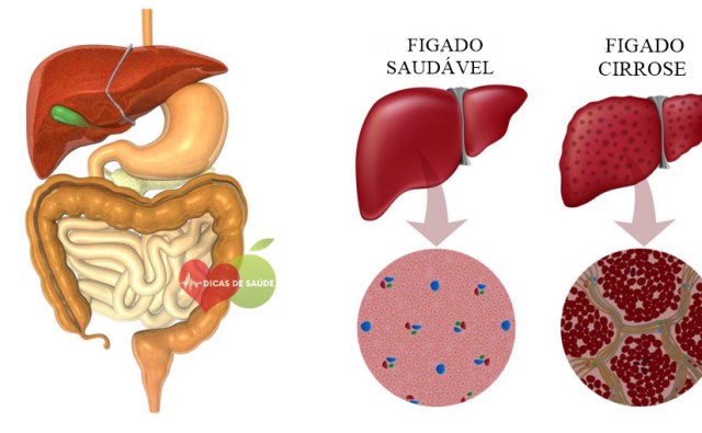 Sintomas da Insuficiência Hepática