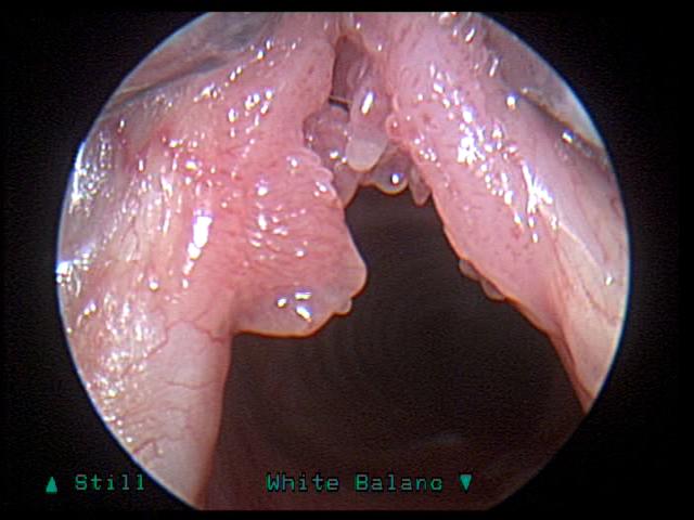 Laryngeal Papilloma seen in laryngoscope