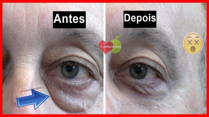 bolsas nos olhos bolsas nos olhos