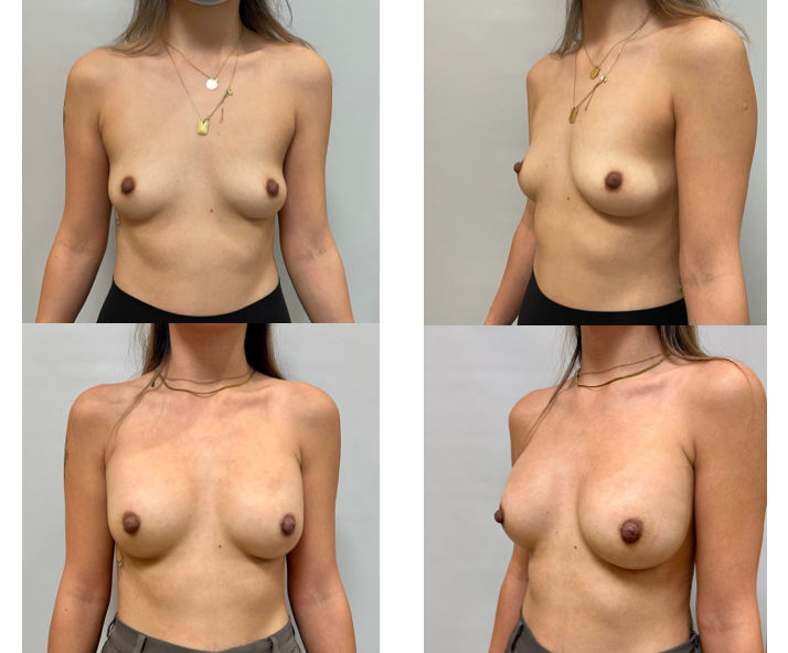 32 Year Old Female Breast Augmentation