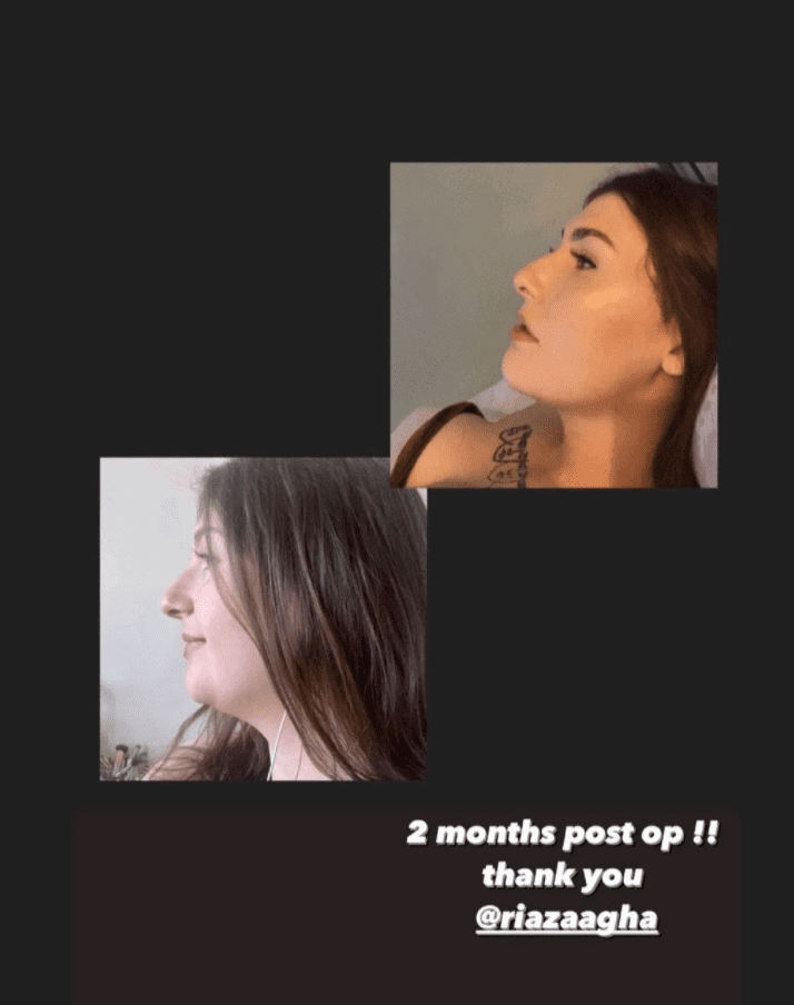 Neck liposuction