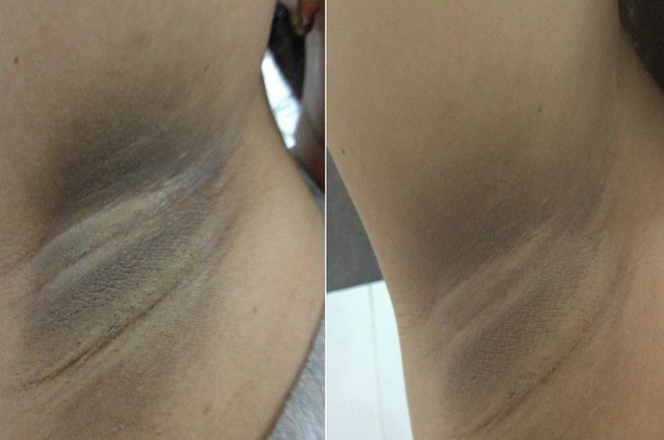 Eliminar os Fungos nas Axilas Eliminar os Fungos nas Axilas