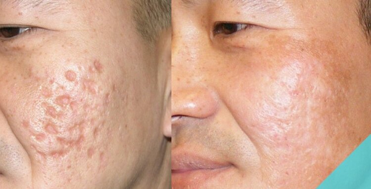 manchas de acne manchas de acne