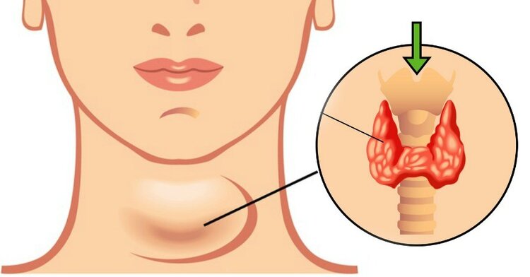 Dieta para tratar o hipotireoidismo: funciona? benefícios e cardápio Dieta para tratar o hipotireoidismo: funciona? benefícios e cardápio