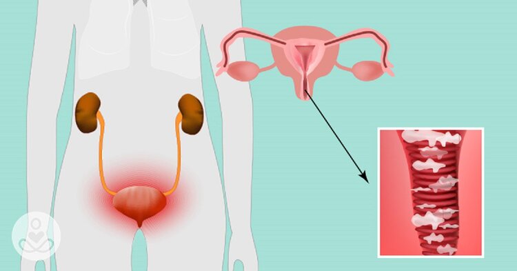 dicas para combater candidíase naturalmente dicas para combater candidíase naturalmente