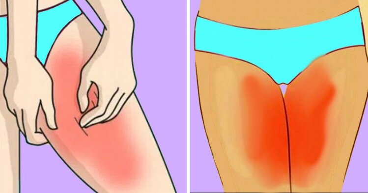 como evitar irritações nas coxas durante o verão como evitar irritações nas coxas durante o verão