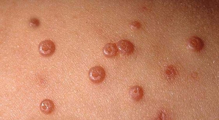 Molusco Contagioso Molusco Contagioso