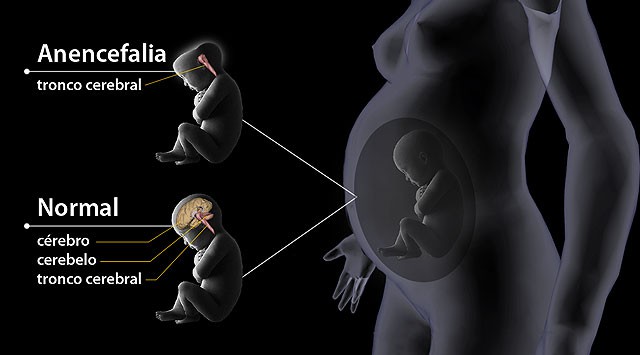 Anencefalia: O que é, causas, diagnostico, prevenção e tratamentos Anencefalia: O que é, causas, diagnostico, prevenção e tratamentos