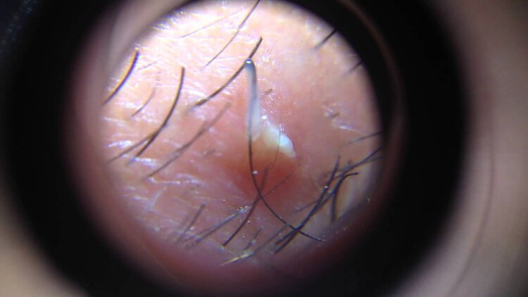 Dicas Para Remover os Pelos Pubianos Encravados em Casa Dicas Para Remover os Pelos Pubianos Encravados em Casa