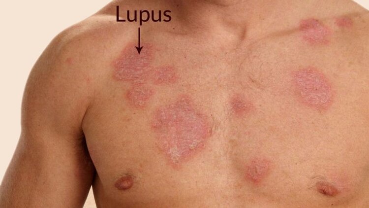 Lúpus Lúpus