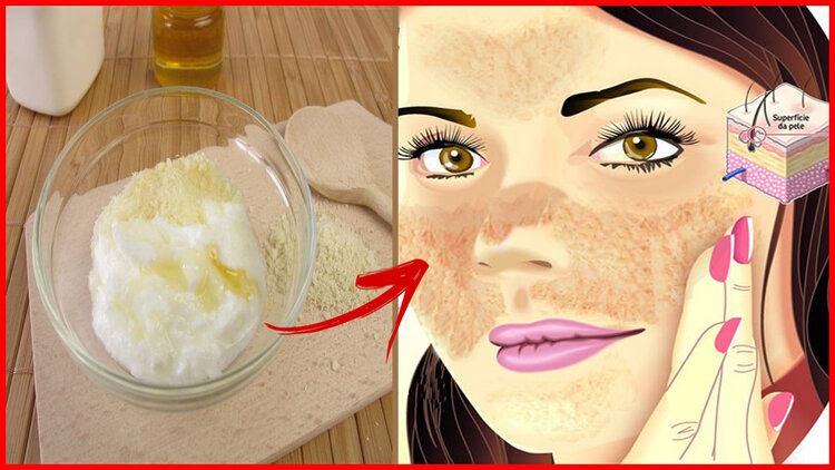 tratamentos caseiros para diminuir melasma tratamentos caseiros para diminuir melasma