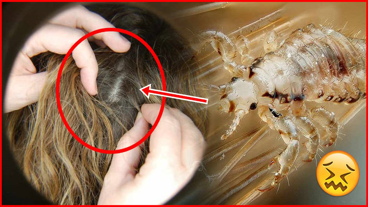 receitas caseiras para eliminar piolhos e lendeas em casa receitas caseiras para eliminar piolhos e lendeas em casa