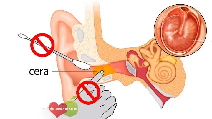 As 6 Dicas de Como Remover Cera do Ouvido | Dicas de Saúde