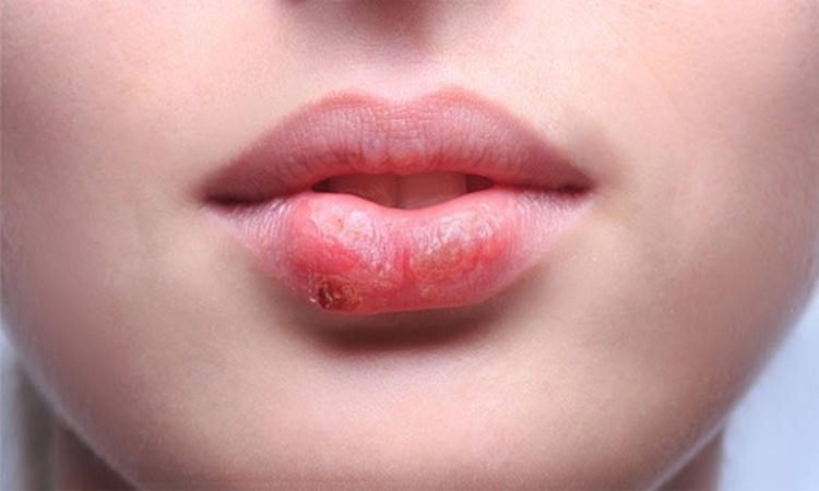 herpes labial herpes labial