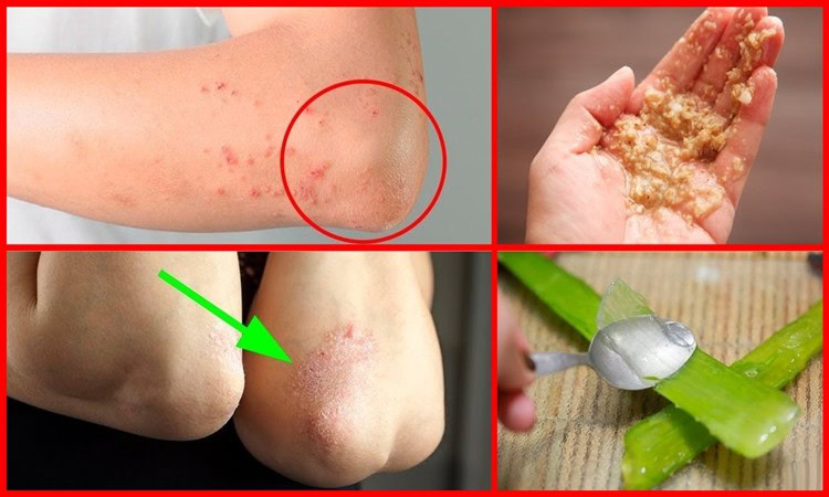 dicas de como se livrar da erupçao cutanea