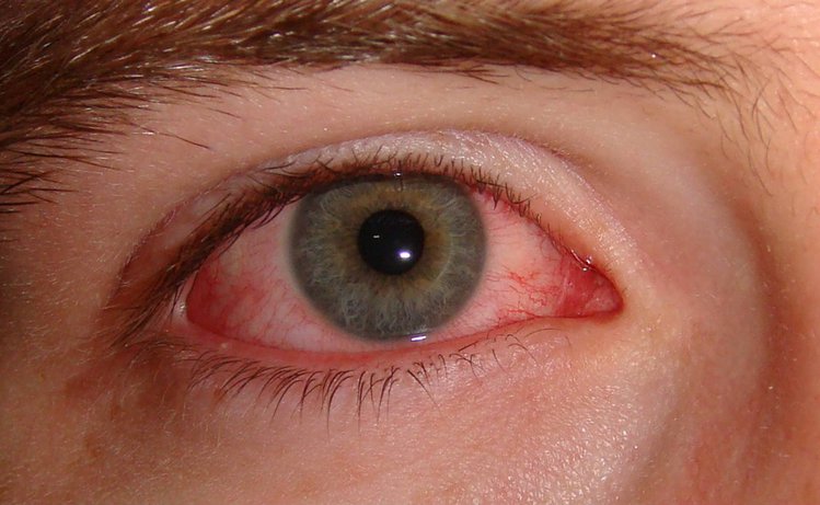 Tracoma Tracoma
