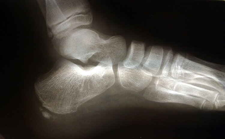 Talalgia Causas Talalgia Causas
