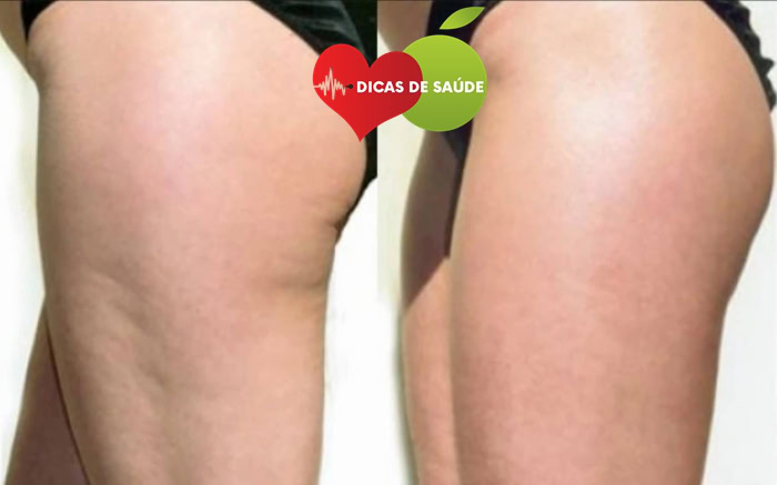 Dicas Para Eliminar as Celulite Dicas Para Eliminar as Celulite