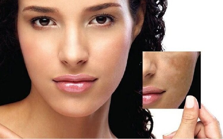 melasma melasma-1