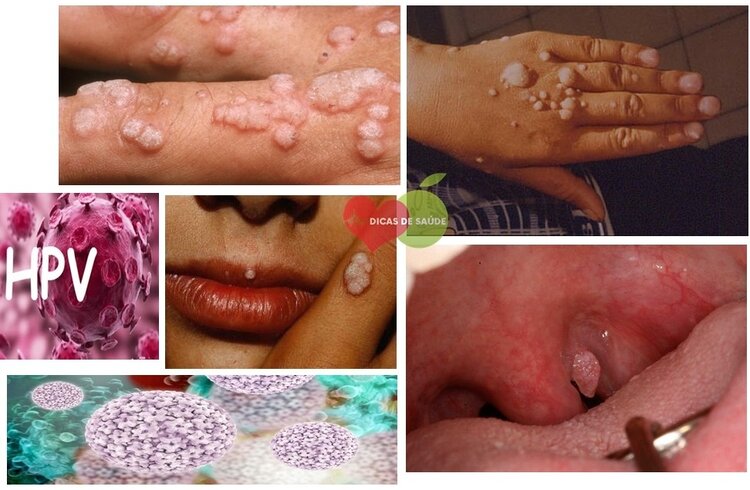 HPV (papilomavírus humano) HPV (papilomavírus humano)
