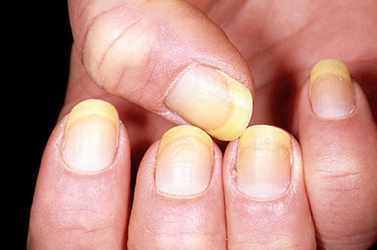Síndrome das Unhas Amarelas Síndrome das Unhas Amarelas