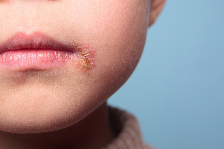 Impetigo - Causas, Sintomas e Tratamentos Impetigo - Causas, Sintomas e Tratamentos
