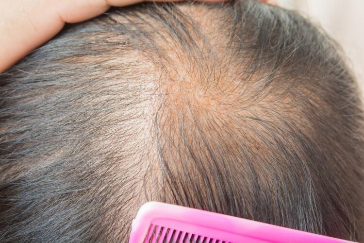 Curas Permanentes Para a Queda de Cabelo Curas Permanentes Para a Queda de Cabelo