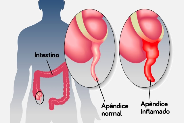 Sintomas da Apendicite Sintomas da Apendicite