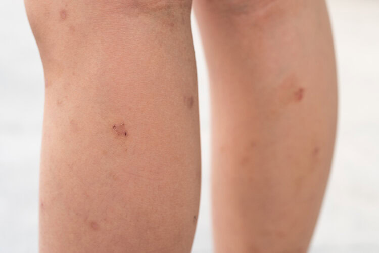 Sarcoma de Kaposi Sarcoma de Kaposi