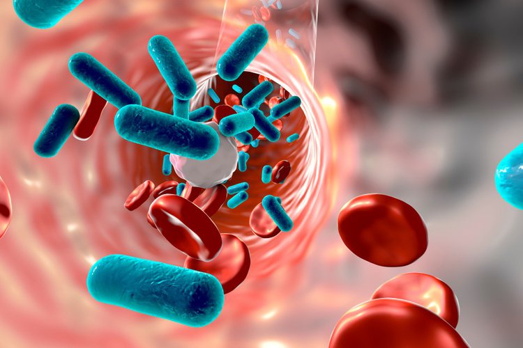 Sepsis Sepsis