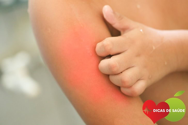 Causas da Dermatite Atópica Causas da Dermatite Atópica