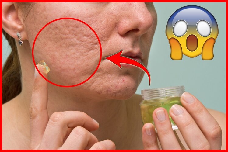 maneiras para eliminar cicatrizes de acne maneiras para eliminar cicatrizes de acne