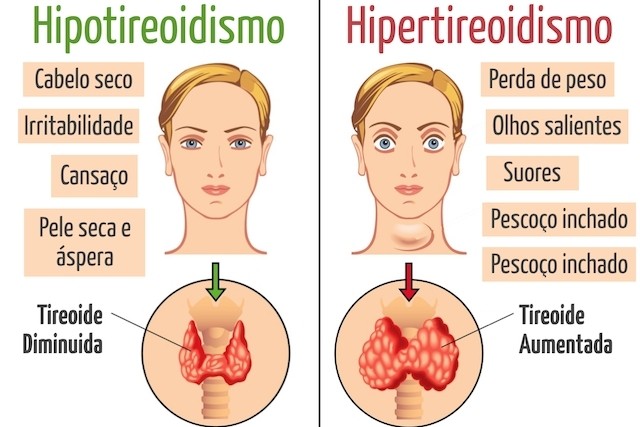 tratar o hipo e hipertireoidismo sem ajuda medica tratar o hipo e hipertireoidismo sem ajuda medica