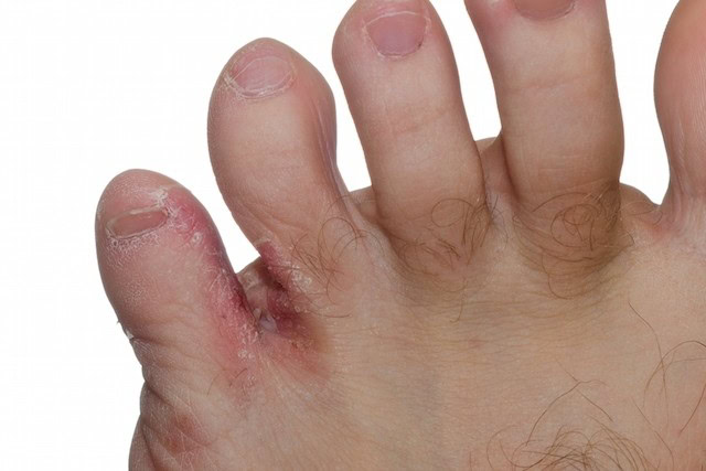Como Acabar com a Frieira de Forma Rápida Como Acabar com a Frieira de Forma Rápida