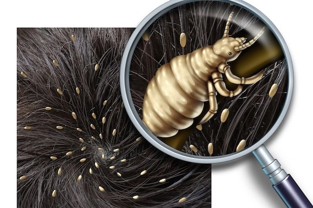 receitas caseiras para eliminar piolhos receitas caseiras para eliminar piolhos