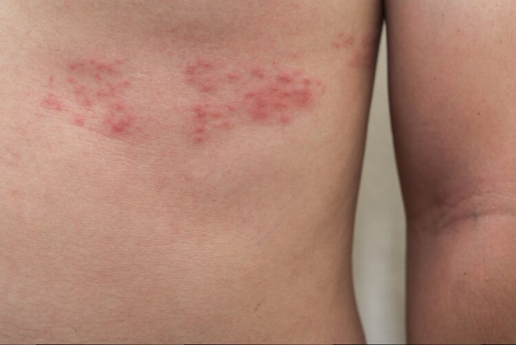 Herpes Zoster