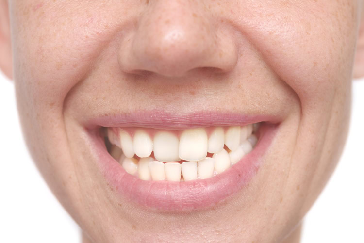 Má Oclusão Dentária