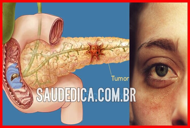 cancer pancreatico cancer pancreatico