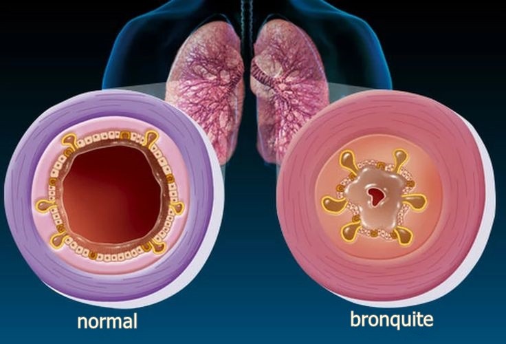 Remédios Caseiros Para Tratar Bronquite Remédios Caseiros Para Tratar Bronquite