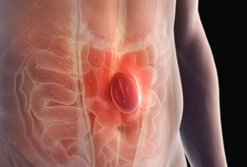 Hernia Ventral Causas Hernia Ventral Causas