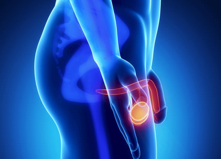 Câncer Testicular Câncer Testicular