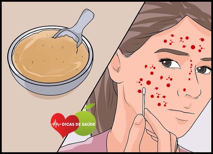 Como Eliminar a Acne em Casa Como Eliminar a Acne em Casa