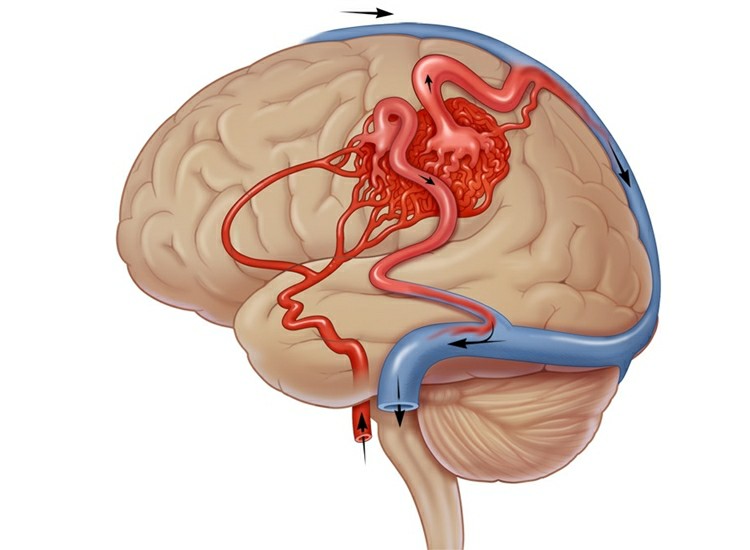 Malformação Arteriovenosa Cerebral Malformação Arteriovenosa Cerebral