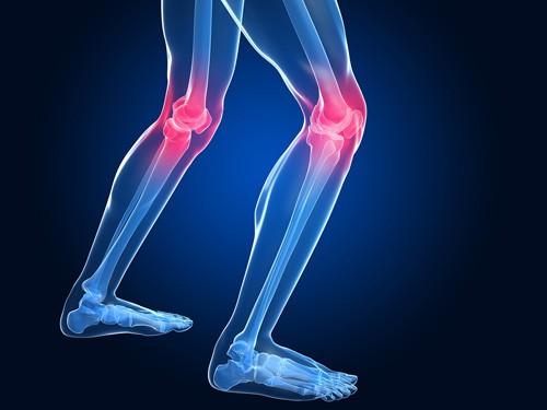 Principais Sintomas da Osteoartrite Principais Sintomas da Osteoartrite