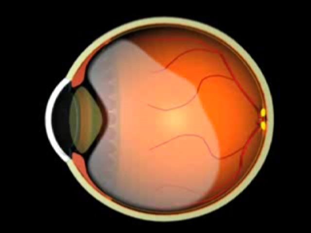 Oclusão da Veia da Retina Oclusão da Veia da Retina