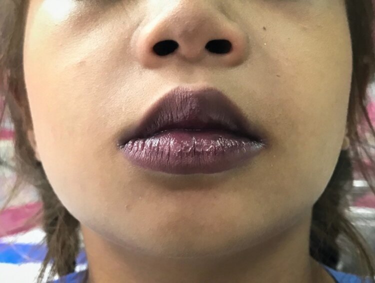 coronavirus causa labios roxo coronavirus causa labios roxo